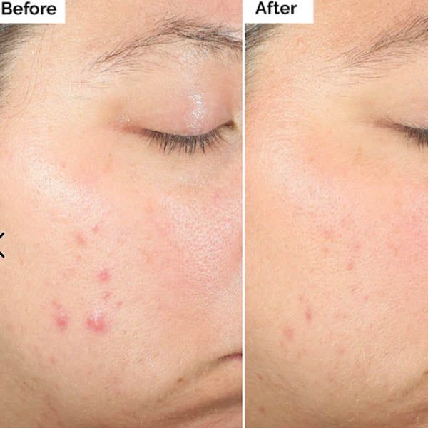 The Ordinary Salicylic Acid 2% Exfoliating Blemish Solution - Vitamins House